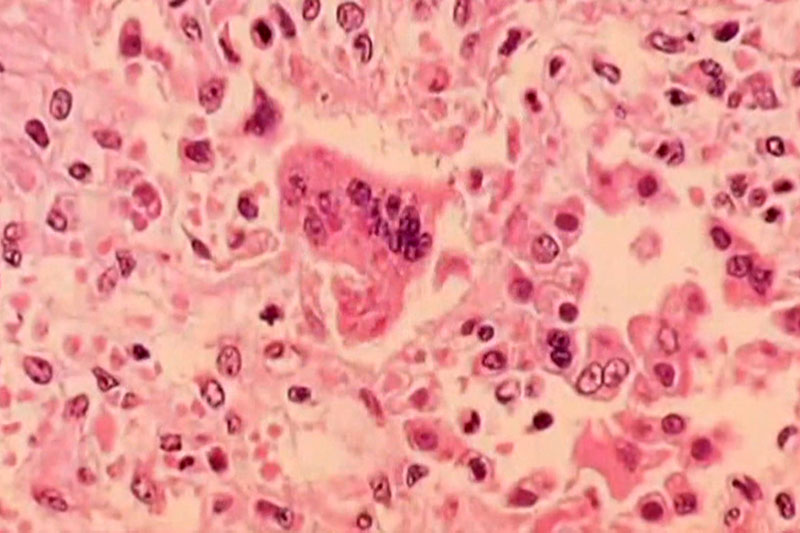 Masernviren unter dem Mikroskop